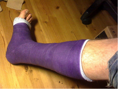 Casted Broken Leg